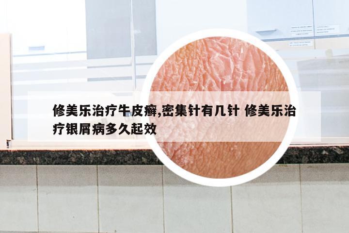 修美乐治疗牛皮癣,密集针有几针 修美乐治疗银屑病多久起效