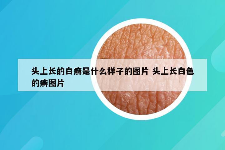 头上长的白癣是什么样子的图片 头上长白色的癣图片