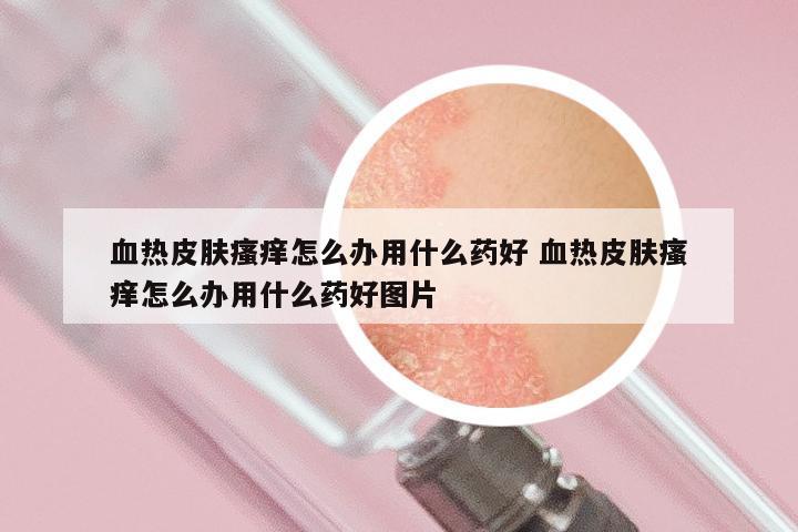 血热皮肤瘙痒怎么办用什么药好 血热皮肤瘙痒怎么办用什么药好图片