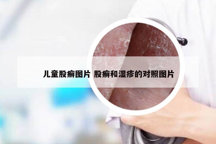 儿童股癣图片 股癣和湿疹的对照图片