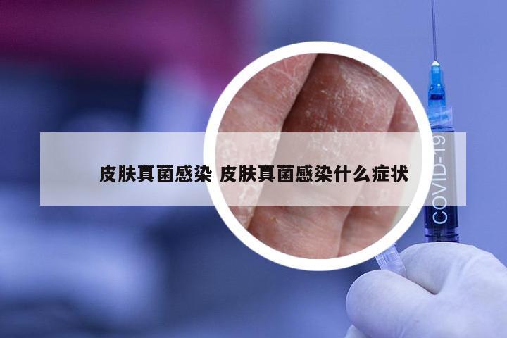 皮肤真菌感染 皮肤真菌感染什么症状