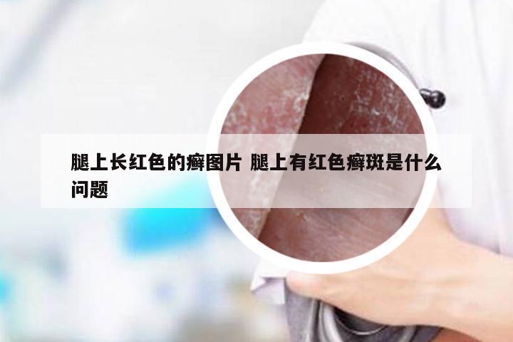 腿上长红色的癣图片 腿上有红色癣斑是什么问题