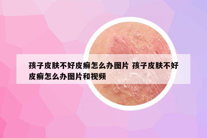 孩子皮肤不好皮癣怎么办图片 孩子皮肤不好皮癣怎么办图片和视频