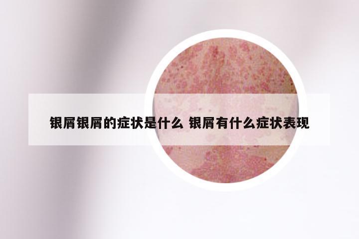 银屑银屑的症状是什么 银屑有什么症状表现
