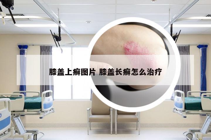 膝盖上癣图片 膝盖长癣怎么治疗