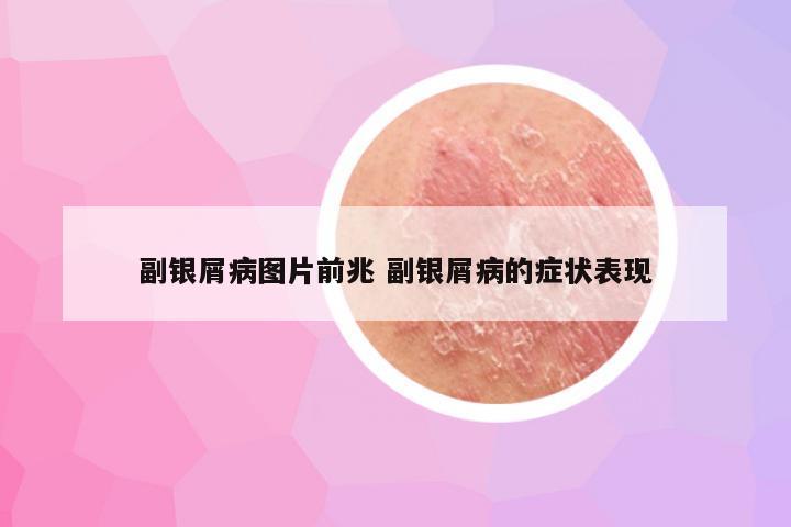 副银屑病图片前兆 副银屑病的症状表现
