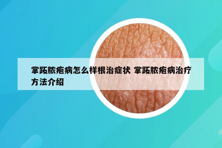掌跖脓疱病怎么样根治症状 掌跖脓疱病治疗方法介绍