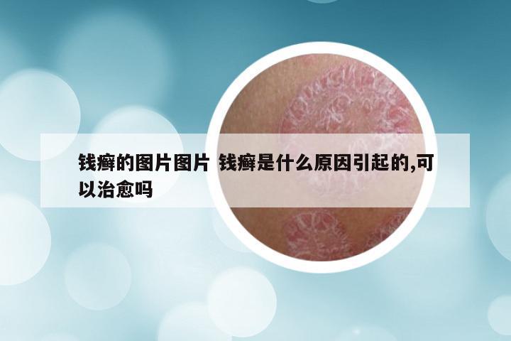 钱癣的图片图片 钱癣是什么原因引起的,可以治愈吗