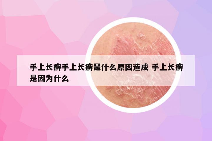 手上长癣手上长癣是什么原因造成 手上长癣是因为什么