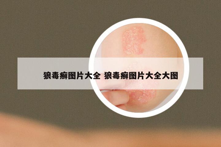 狼毒癣图片大全 狼毒癣图片大全大图