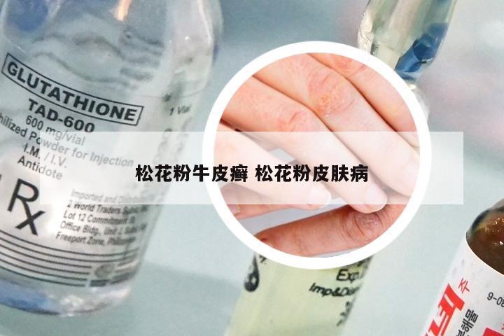 松花粉牛皮癣 松花粉皮肤病