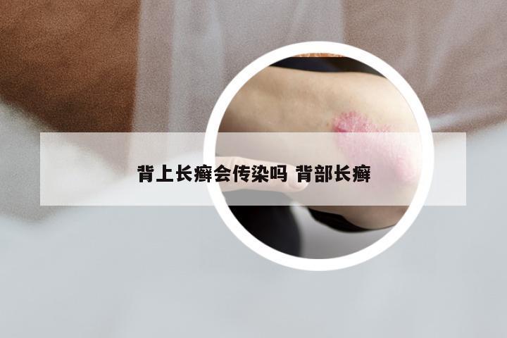 背上长癣会传染吗 背部长癣