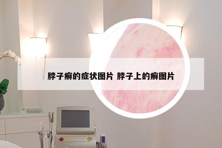 脖子癣的症状图片 脖子上的癣图片