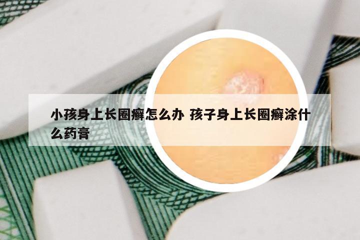 小孩身上长圈癣怎么办 孩子身上长圈癣涂什么药膏