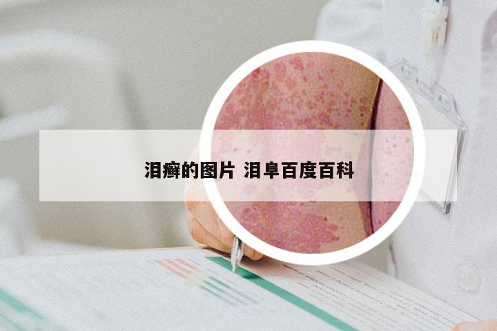 泪癣的图片 泪阜百度百科