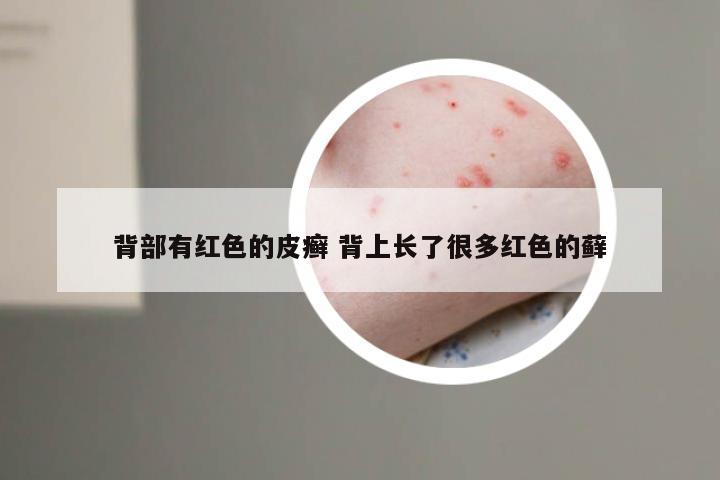 背部有红色的皮癣 背上长了很多红色的藓