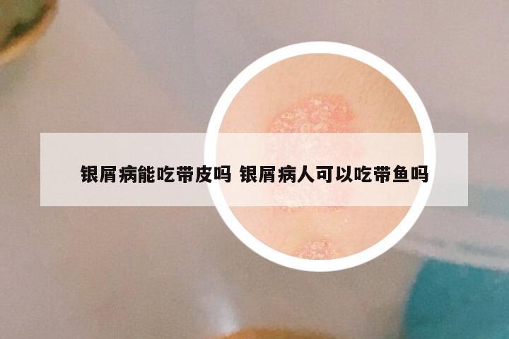 银屑病能吃带皮吗 银屑病人可以吃带鱼吗