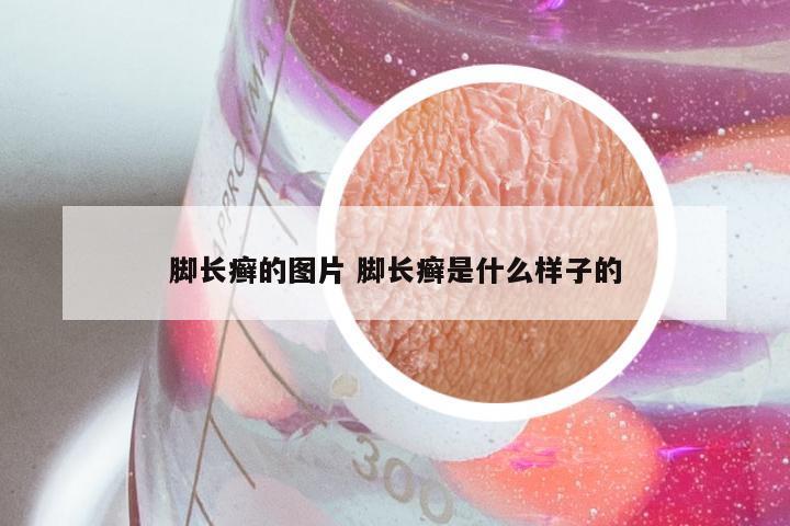 脚长癣的图片 脚长癣是什么样子的