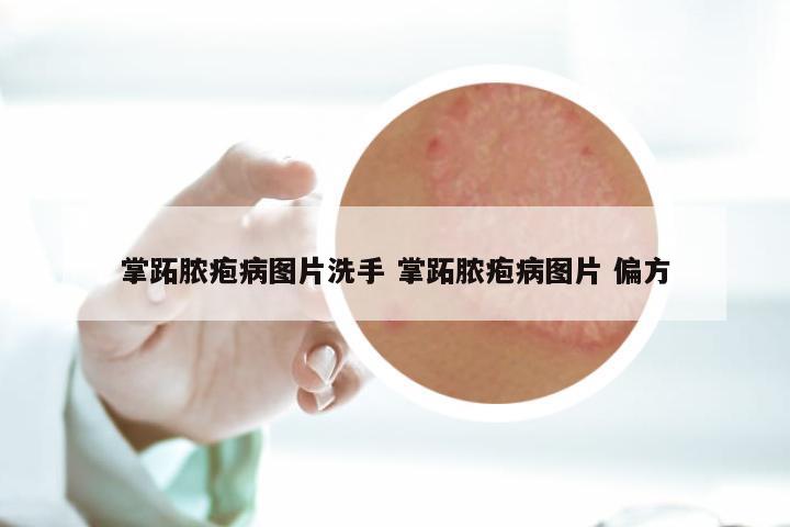 掌跖脓疱病图片洗手 掌跖脓疱病图片 偏方