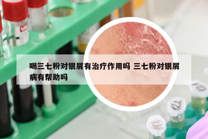 喝三七粉对银屑有治疗作用吗 三七粉对银屑病有帮助吗