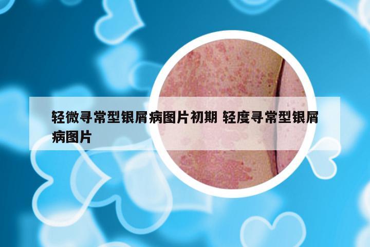 轻微寻常型银屑病图片初期 轻度寻常型银屑病图片