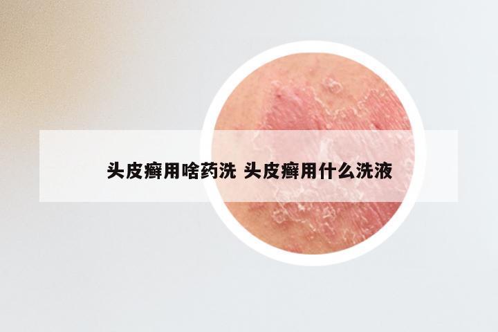 头皮癣用啥药洗 头皮癣用什么洗液