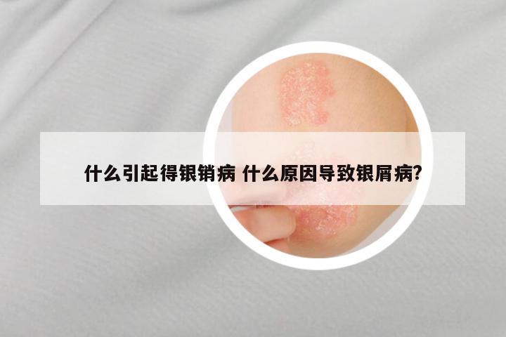 什么引起得银销病 什么原因导致银屑病?