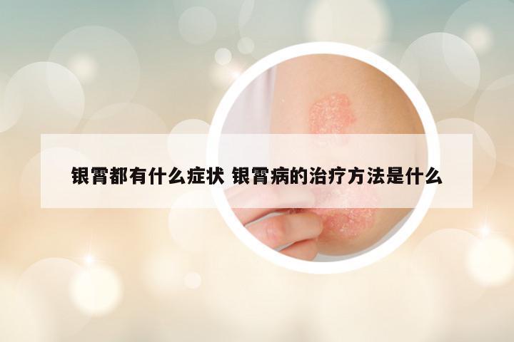 银霄都有什么症状 银霄病的治疗方法是什么