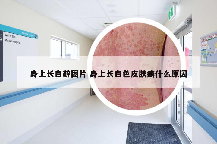 身上长白藓图片 身上长白色皮肤癣什么原因