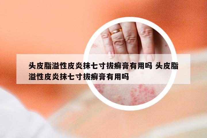 头皮脂溢性皮炎抹七寸拔癣膏有用吗 头皮脂溢性皮炎抹七寸拔癣膏有用吗