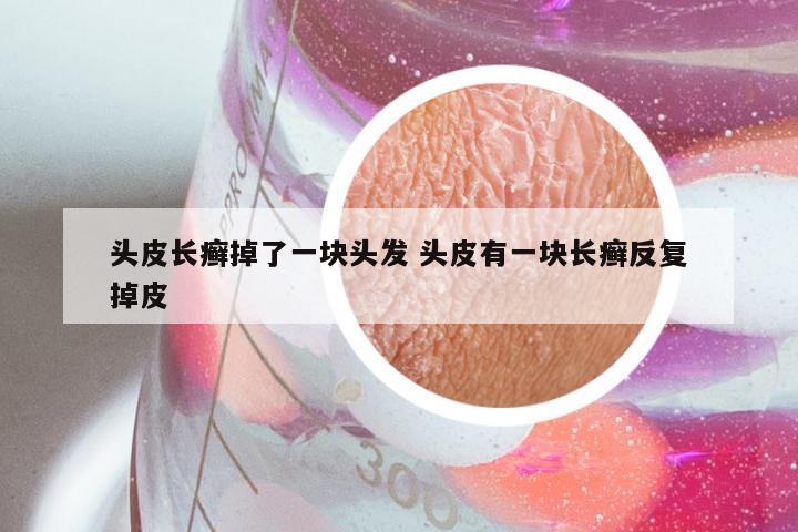 头皮长癣掉了一块头发 头皮有一块长癣反复掉皮