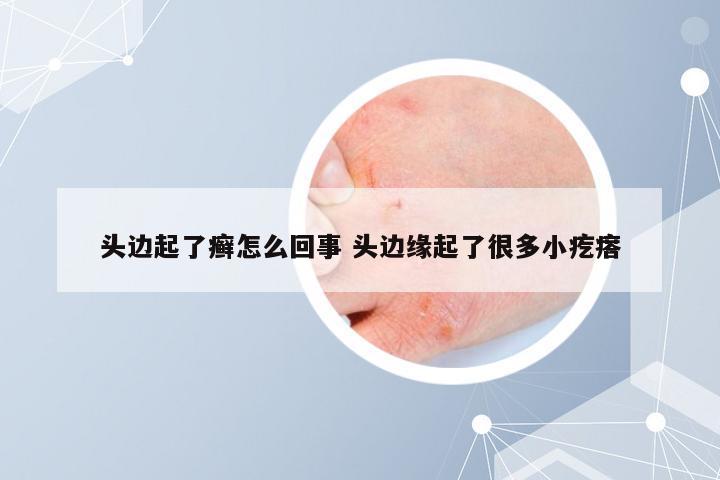头边起了癣怎么回事 头边缘起了很多小疙瘩