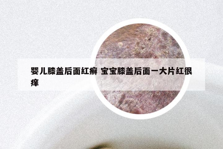 婴儿膝盖后面红癣 宝宝膝盖后面一大片红很痒
