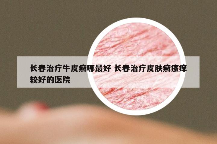 长春治疗牛皮癣哪最好 长春治疗皮肤癣瘙痒较好的医院