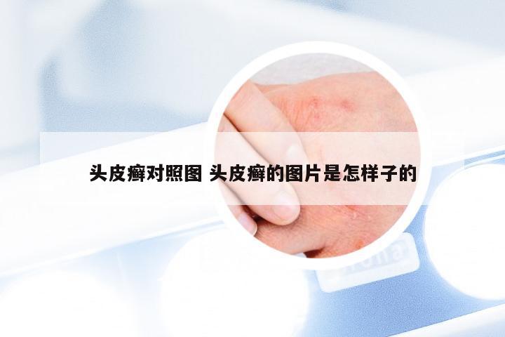 头皮癣对照图 头皮癣的图片是怎样子的