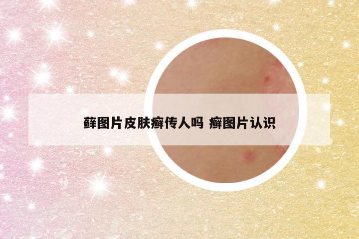 藓图片皮肤癣传人吗 癣图片认识