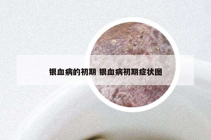 银血病的初期 银血病初期症状图