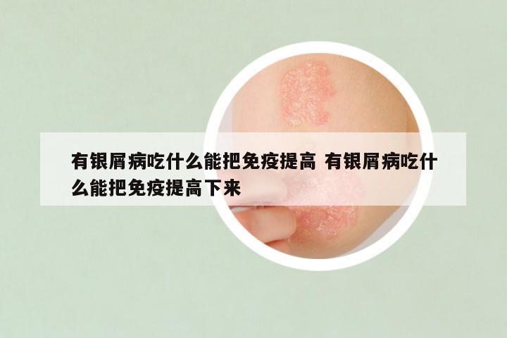 有银屑病吃什么能把免疫提高 有银屑病吃什么能把免疫提高下来