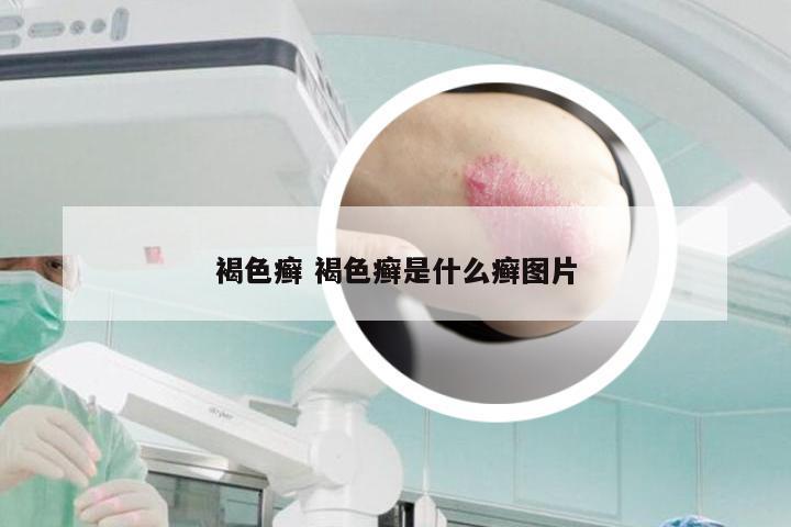 褐色癣 褐色癣是什么癣图片