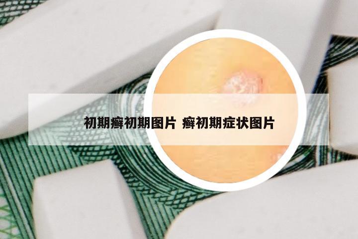 初期癣初期图片 癣初期症状图片