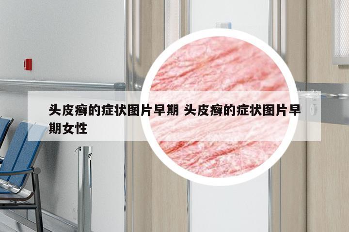 头皮癣的症状图片早期 头皮癣的症状图片早期女性