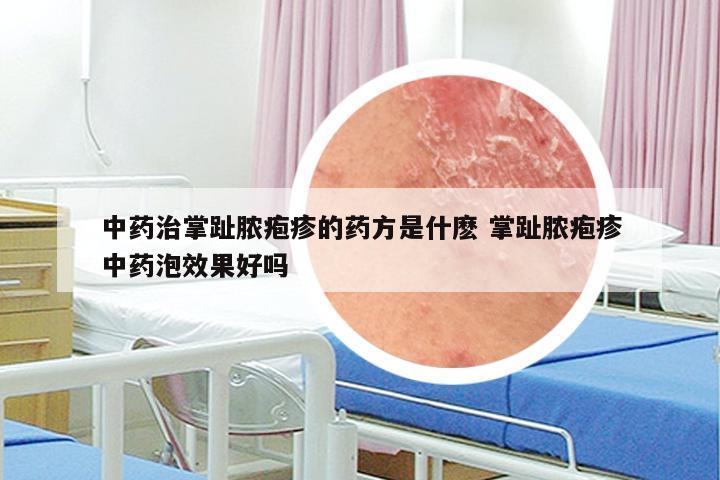 中药治掌趾脓疱疹的药方是什麽 掌趾脓疱疹中药泡效果好吗