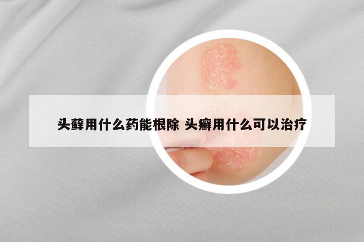 头藓用什么药能根除 头癣用什么可以治疗