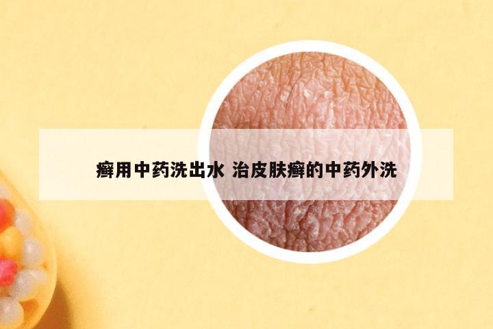 癣用中药洗出水 治皮肤癣的中药外洗