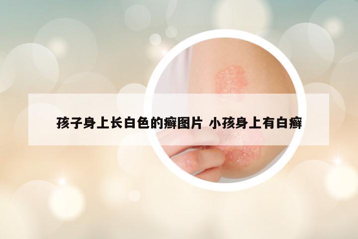 孩子身上长白色的癣图片 小孩身上有白癣