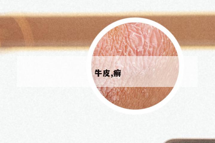 牛皮,癣