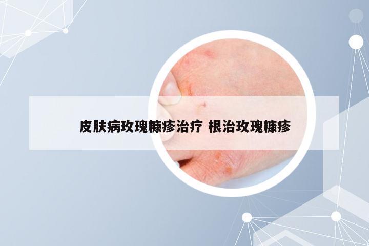 皮肤病玫瑰糠疹治疗 根治玫瑰糠疹