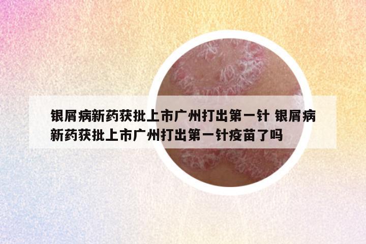 银屑病新药获批上市广州打出第一针 银屑病新药获批上市广州打出第一针疫苗了吗