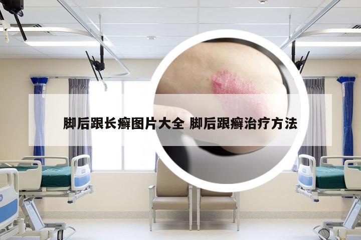 脚后跟长癣图片大全 脚后跟癣治疗方法