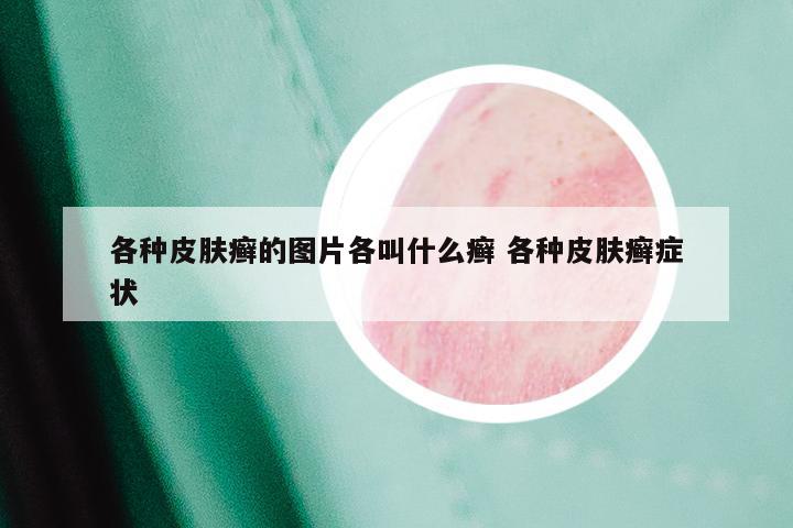 各种皮肤癣的图片各叫什么癣 各种皮肤癣症状